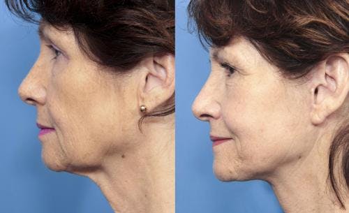 Neck Lift Before & After Gallery - Patient 58213291 - Image 1