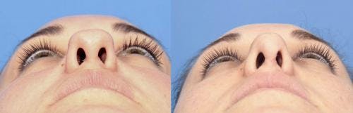Rhinoplasty Before & After Gallery - Patient 58213292 - Image 3