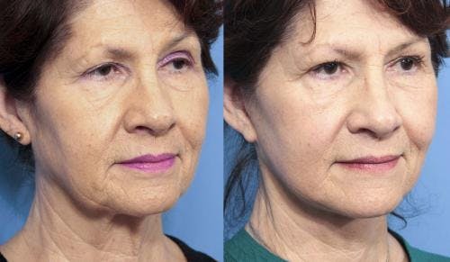 Neck Lift Before & After Gallery - Patient 58213291 - Image 4