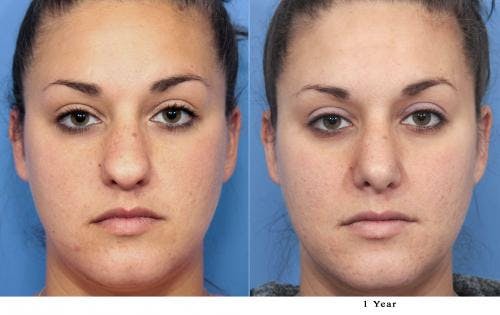 Rhinoplasty Before & After Gallery - Patient 58213292 - Image 2