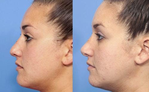 Rhinoplasty Before & After Gallery - Patient 58213292 - Image 1