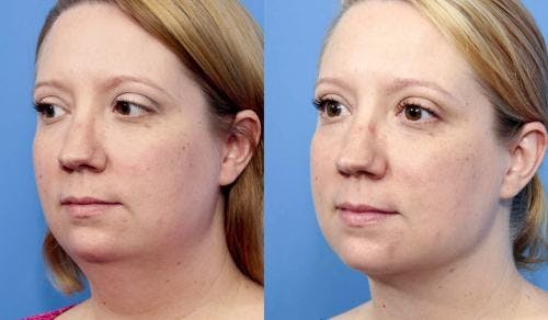 Neck Lift Before & After Gallery - Patient 58213293 - Image 2