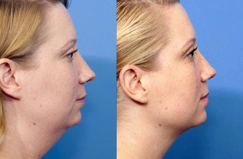 Neck Lift Before & After Gallery - Patient 58213293 - Image 5
