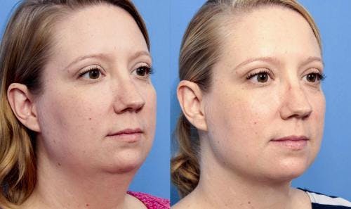 Neck Lift Before & After Gallery - Patient 58213293 - Image 4