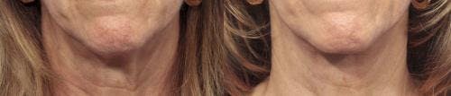 Neck Lift Before & After Gallery - Patient 58213295 - Image 2