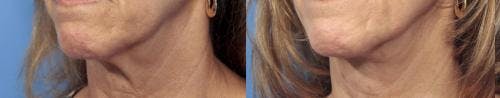 Neck Lift Before & After Gallery - Patient 58213295 - Image 1