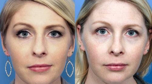 Rhinoplasty Before & After Gallery - Patient 58213297 - Image 2