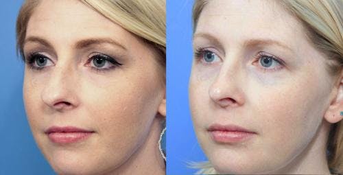 Rhinoplasty Before & After Gallery - Patient 58213297 - Image 3