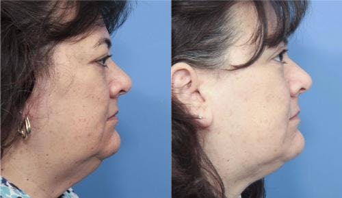 Neck Lift Before & After Gallery - Patient 58213296 - Image 1