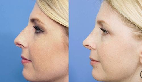 Rhinoplasty Before & After Gallery - Patient 58213297 - Image 1
