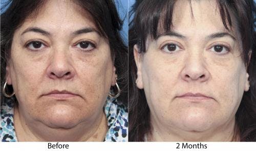 Neck Lift Before & After Gallery - Patient 58213296 - Image 2