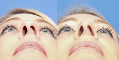 Rhinoplasty Before & After Gallery - Patient 58213297 - Image 4