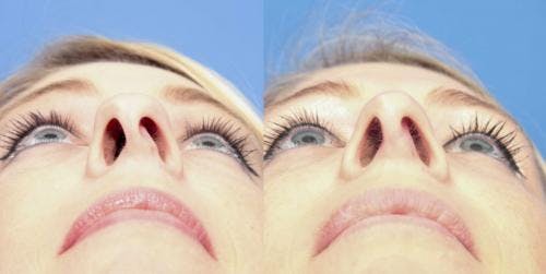 Rhinoplasty Before & After Gallery - Patient 58213297 - Image 4