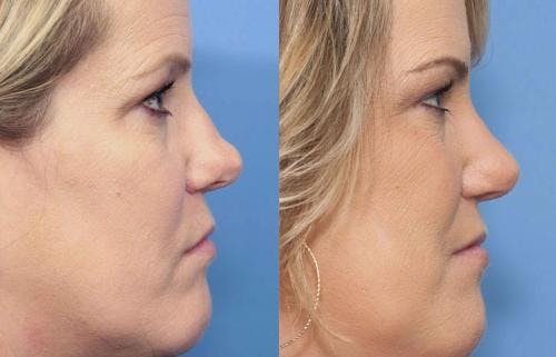 Rhinoplasty Before & After Gallery - Patient 58213305 - Image 1
