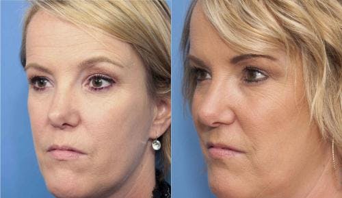 Rhinoplasty Before & After Gallery - Patient 58213305 - Image 2