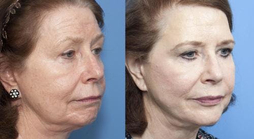 Neck Lift Before & After Gallery - Patient 58213306 - Image 4