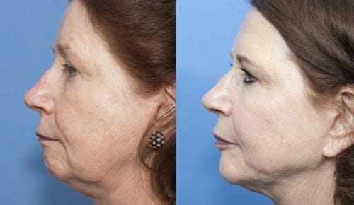 Neck Lift Before & After Gallery - Patient 58213306 - Image 1