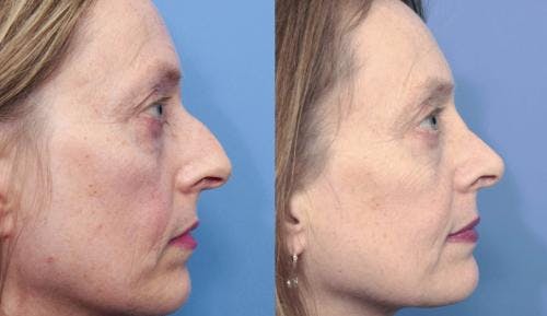 Rhinoplasty Before & After Gallery - Patient 58213307 - Image 1