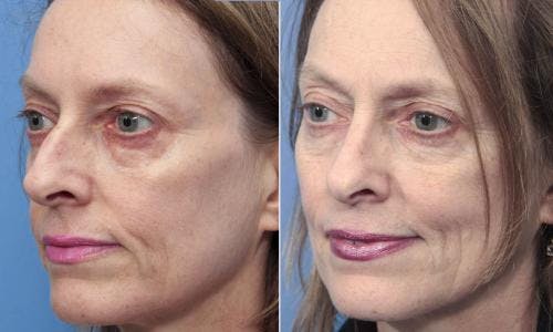 Rhinoplasty Before & After Gallery - Patient 58213307 - Image 2