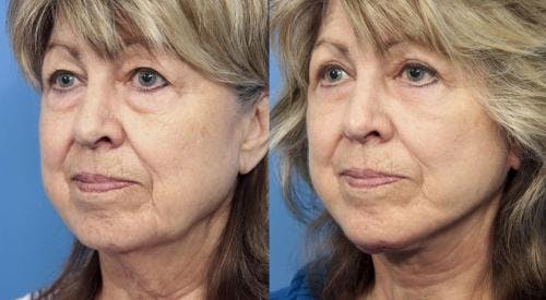 Neck Lift Before & After Gallery - Patient 58213308 - Image 2
