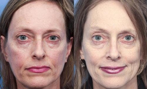 Rhinoplasty Before & After Gallery - Patient 58213307 - Image 3