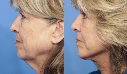 Neck Lift Before & After Gallery - Patient 58213308 - Image 1