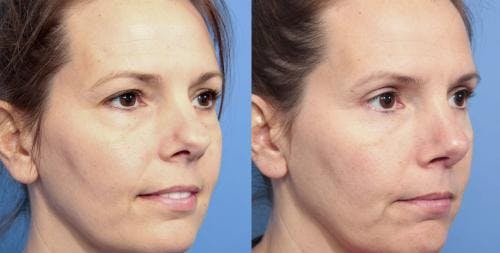 Rhinoplasty Before & After Gallery - Patient 58213309 - Image 1