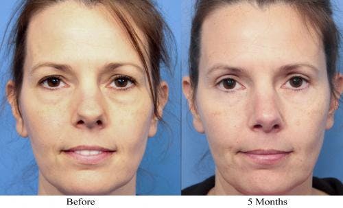 Rhinoplasty Before & After Gallery - Patient 58213309 - Image 2