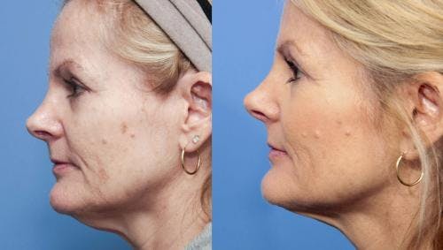 Neck Lift Before & After Gallery - Patient 58213310 - Image 1