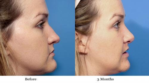 Rhinoplasty Before & After Gallery - Patient 58213312 - Image 1