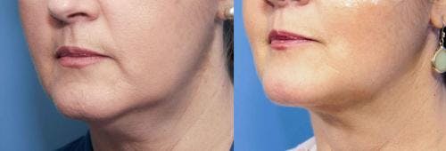 Neck Lift Before & After Gallery - Patient 58213311 - Image 2