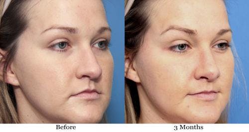 Rhinoplasty Before & After Gallery - Patient 58213312 - Image 2