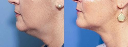 Neck Lift Before & After Gallery - Patient 58213311 - Image 1
