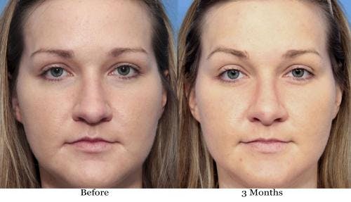 Rhinoplasty Before & After Gallery - Patient 58213312 - Image 3