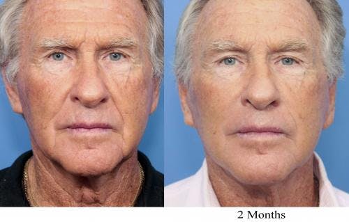 Neck Lift Before & After Gallery - Patient 58213313 - Image 2