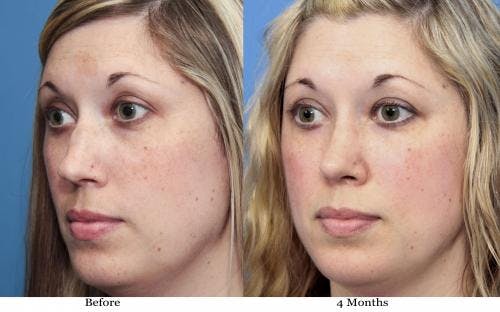 Rhinoplasty Before & After Gallery - Patient 58213314 - Image 2