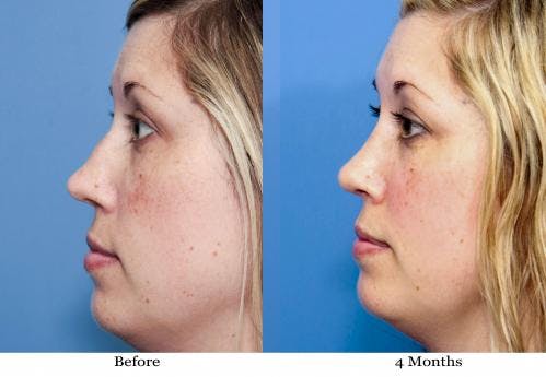 Rhinoplasty Before & After Gallery - Patient 58213314 - Image 1