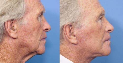Neck Lift Before & After Gallery - Patient 58213313 - Image 1
