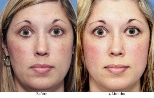 Rhinoplasty Before & After Gallery - Patient 58213314 - Image 3