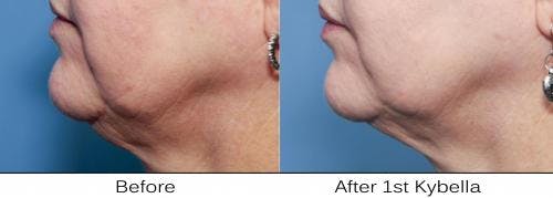 Neck Lift Before & After Gallery - Patient 58213315 - Image 1