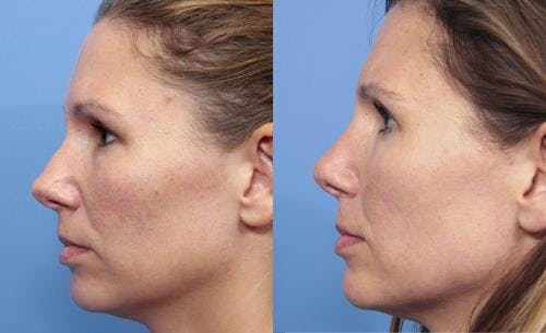 Rhinoplasty Before & After Gallery - Patient 58213316 - Image 1