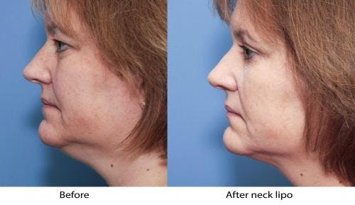 Neck Lift Before & After Gallery - Patient 58213317 - Image 1