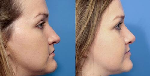 Rhinoplasty Before & After Gallery - Patient 58213319 - Image 1