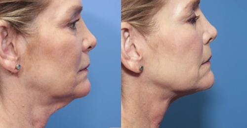 Neck Lift Before & After Gallery - Patient 58213318 - Image 1