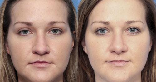 Rhinoplasty Before & After Gallery - Patient 58213319 - Image 3