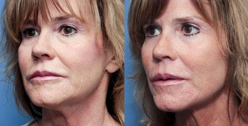 Neck Lift Before & After Gallery - Patient 58213321 - Image 3