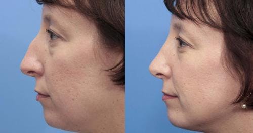 Rhinoplasty Before & After Gallery - Patient 58213320 - Image 1