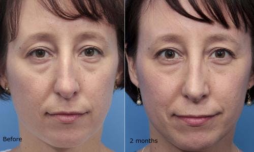 Rhinoplasty Before & After Gallery - Patient 58213320 - Image 2