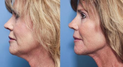 Neck Lift Before & After Gallery - Patient 58213321 - Image 1