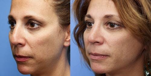 Rhinoplasty Before & After Gallery - Patient 58213322 - Image 1